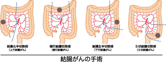 前方 術 高位 切除