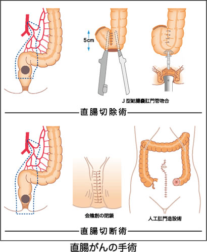 大腸がんについて 近畿大学医学部 外科学教室