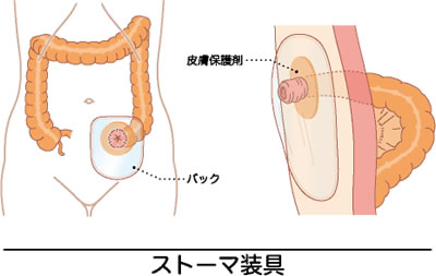 大腸がんについて 近畿大学医学部 外科学教室