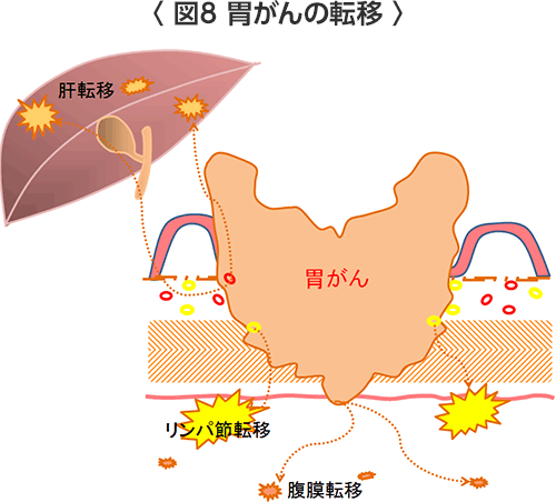 胃がん ステージ 4 ブログ