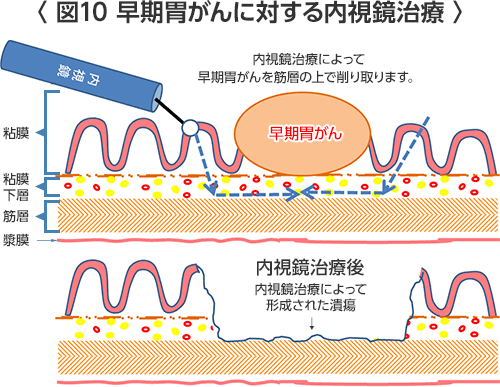 胃がん スキルス