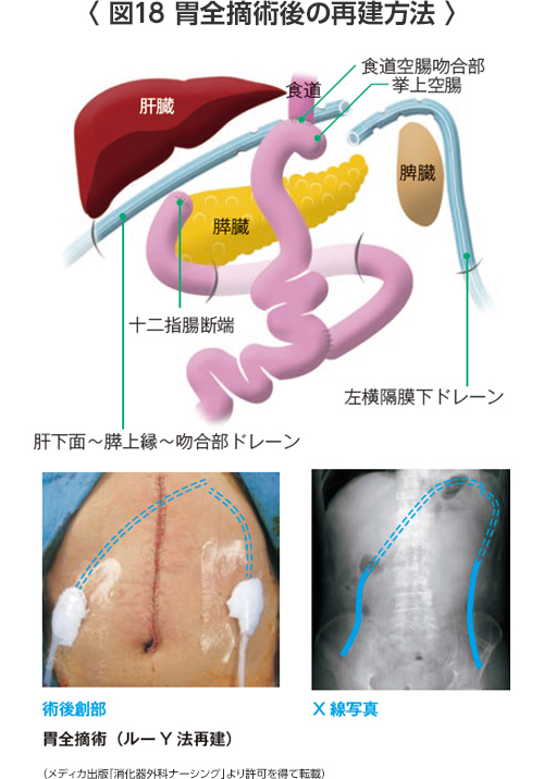 姑息 手術 と は