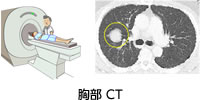 胸部CT