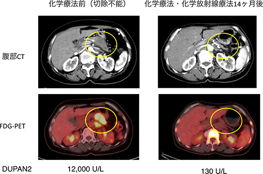 コンバージョン手術症例 化学療法前（切除不能）と化学療法・化学放射線療法14ヶ月後の違い