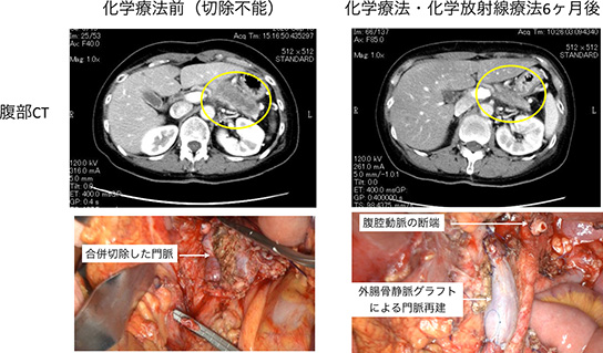 コンバージョン手術症例 化学療法前(切除不能)と化学療法・化学放射線療法14ヶ月後の違い