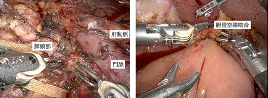 ロボット支援下膵頭十二指腸切除術の写真
