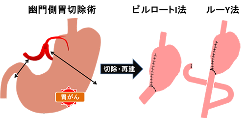 幽門側胃切除術、切除・再建、ビルロートI法・ルーY法