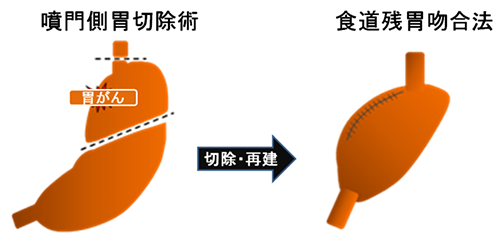 噴門側胃切除術、切除・再建、食堂残胃吻合法