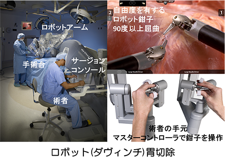 ロボット（ダヴィンチ）胃切除