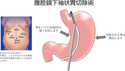 腹腔鏡下袖状胃切除術