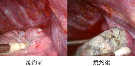 spontaneous_pneumothorax_02.png