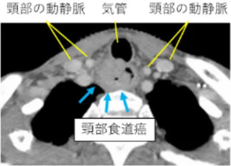 頸部食道癌 ～声を残す手術 喉頭温存手術～ - 近畿大学医学部外科学教室