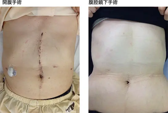 膵疾患に対する低侵襲手術 〜ロボット支援下手術・腹腔鏡下手術