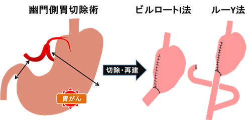 手術の方法 ～開腹胃切除、腹腔鏡下胃切除、ロボット（ダヴィンチ）胃